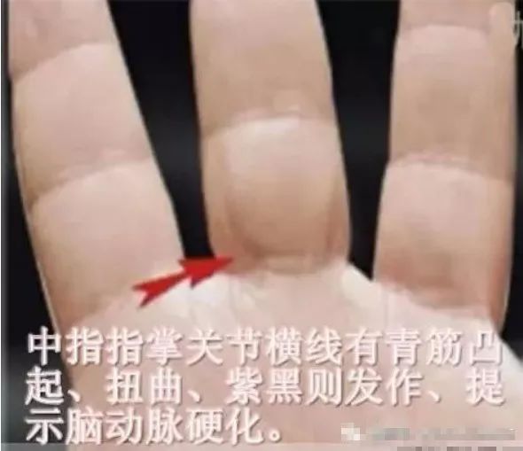 冬天,刮一刮这里可以防治脑血栓,中老年人靠它保命!