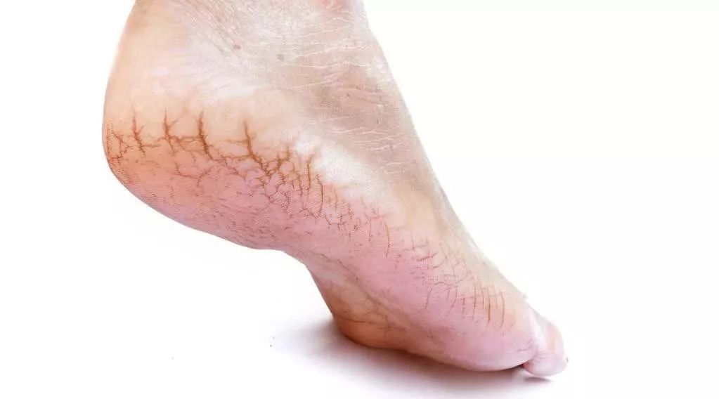 脚上老皮,老茧不用急,教你一招小妙方,轻松解决!