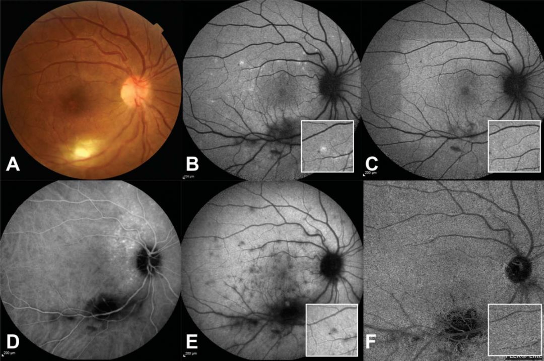 结果显示,所有检查手段都可见明显的弓形虫感染相关的急性视网膜病灶