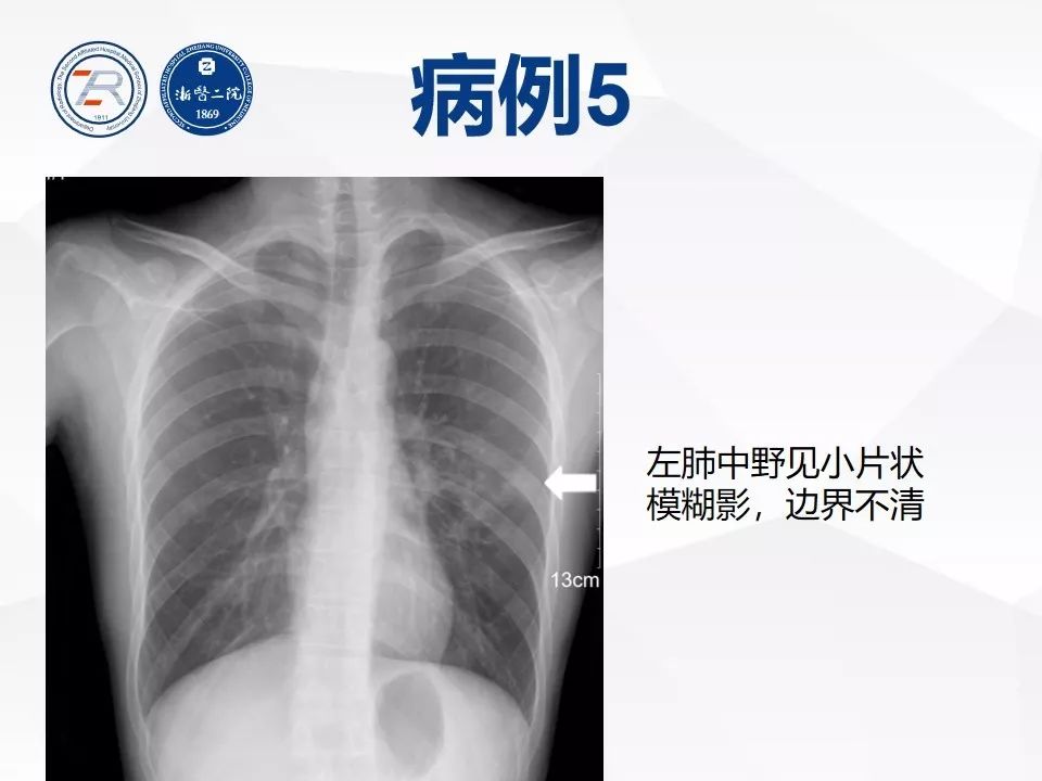 肺炎的x光片图片