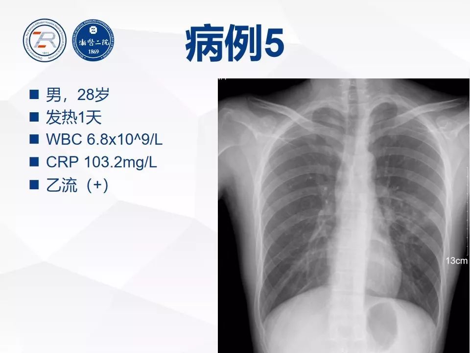 如何在x线胸片上诊断病毒性肺炎
