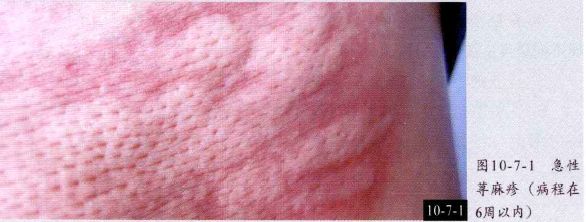 44银屑病45玫瑰糠疹46白色糠疹47扁平苔藓48毛发红糠疹49红皮病50红斑