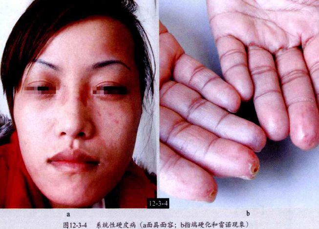 炎66荨麻疹性血管炎67鱼鳞病68毛发角化病69汗孔角化症70掌跖角化病