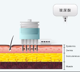 水光针注射层次 图解图片