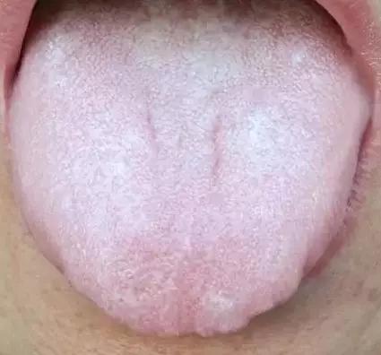 舌头中间有裂纹或者边缘有齿痕等可能是疾病征兆
