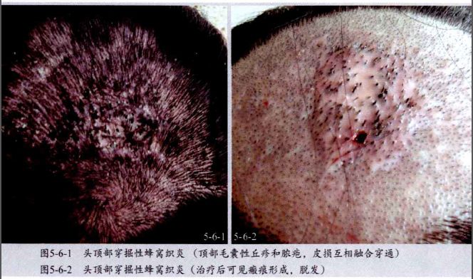 毛囊炎12丹毒11葡萄球菌性燙傷樣皮膚綜合徵10膿皰病9傳染性紅斑8帶狀