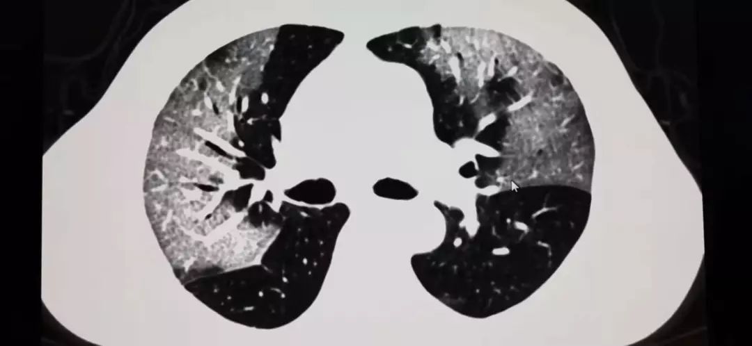 新冠肺炎肺部照片图片