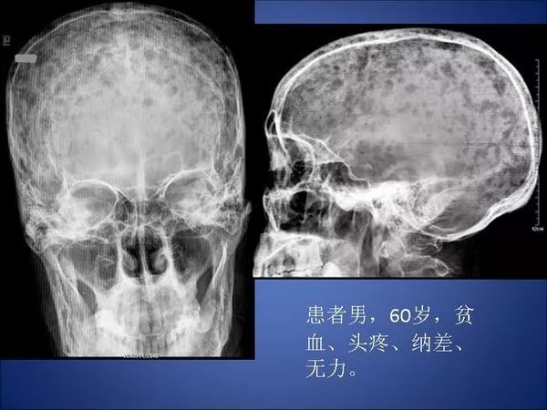 多发性骨髓瘤的影像学表现