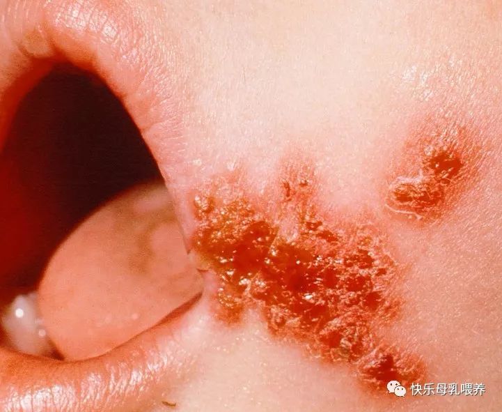 唇疱疹引起美国儿科学会育儿百科中认为,唇疱疹是由单纯疱疹病毒引起