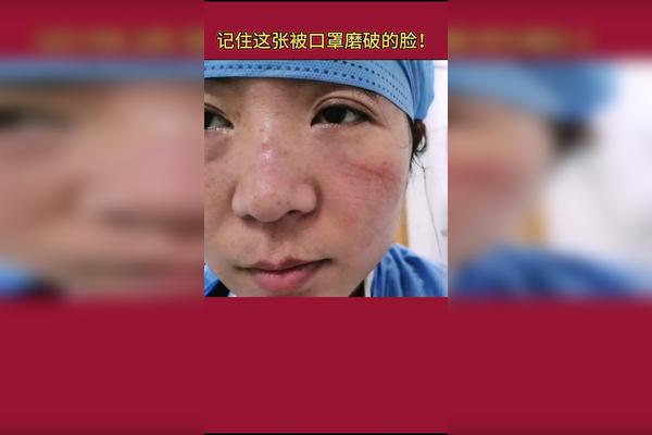 科倪芳护士长和93年的护士袁婷一天戴8个多小时口罩脸都被口罩磨破了