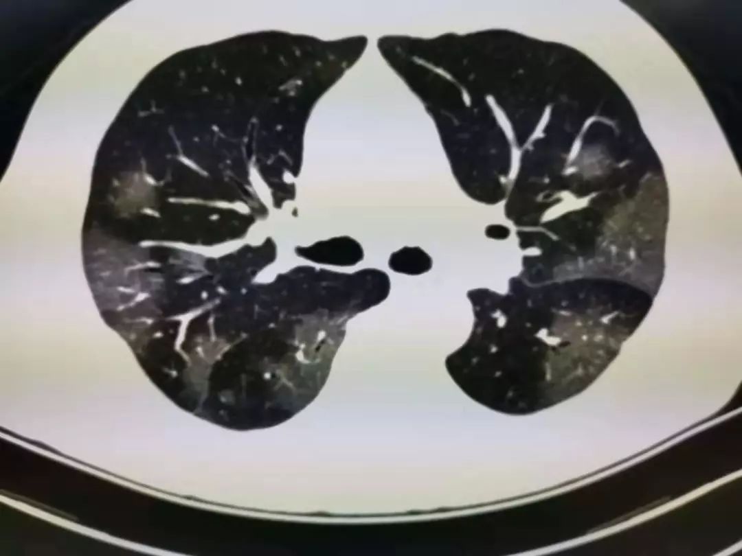 新冠病毒是如何攻击患者肺部的?8张影像图给了答案