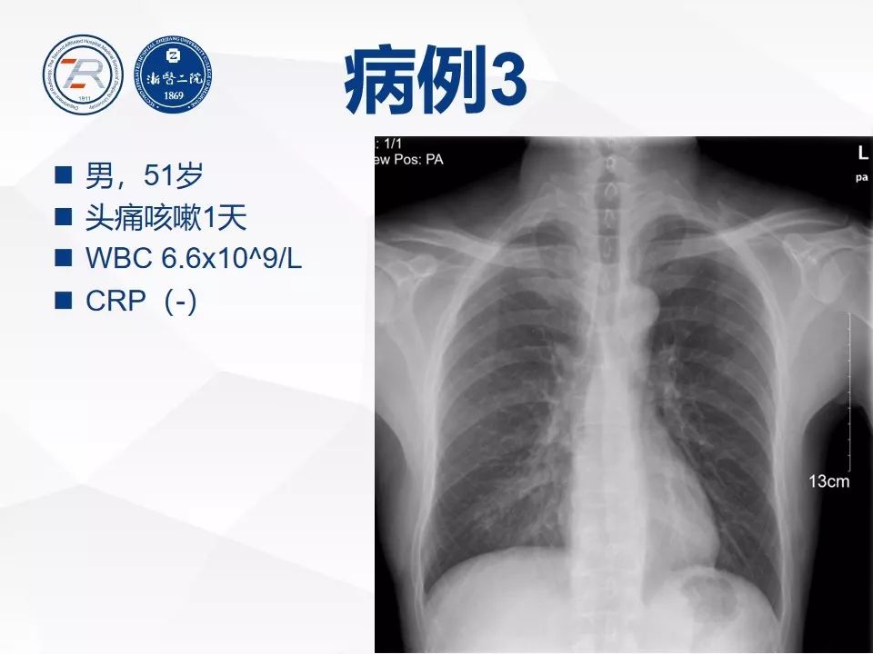 如何在x線胸片上診斷病毒性肺炎