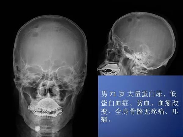 颅骨多发性骨髓瘤图片