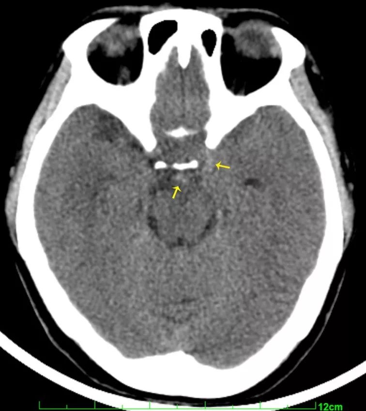 左侧颈内动脉后交通段动脉瘤;诊断:辅助检查:头颅cta示"左侧颈内动脉
