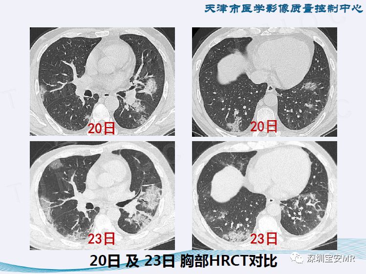 新冠肺炎片子图片