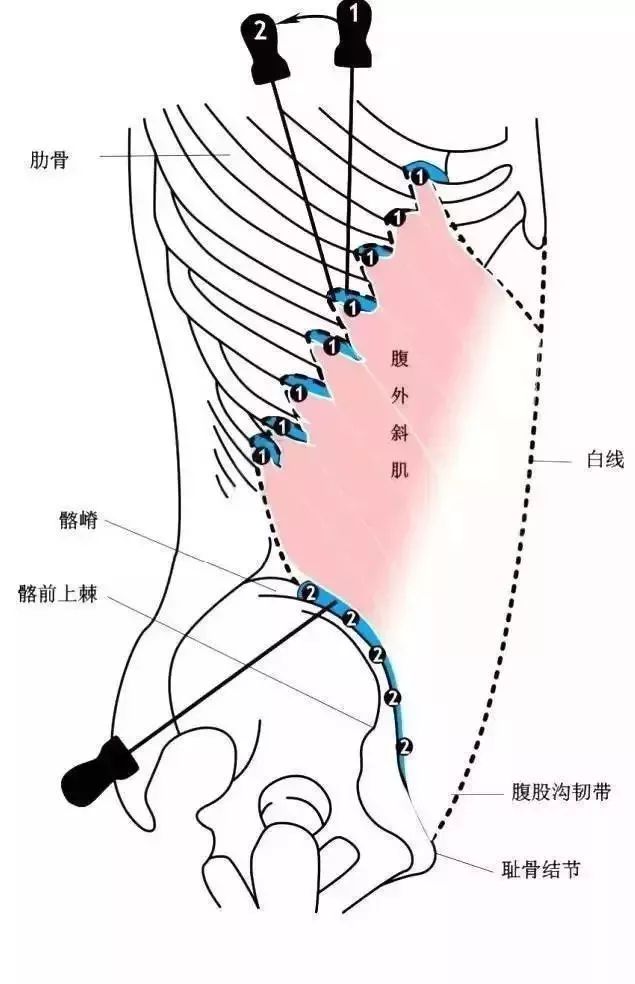 ①肋骨面上的压痛点刀口线和腹外斜肌纤维走向平行,刀体与皮面垂直.