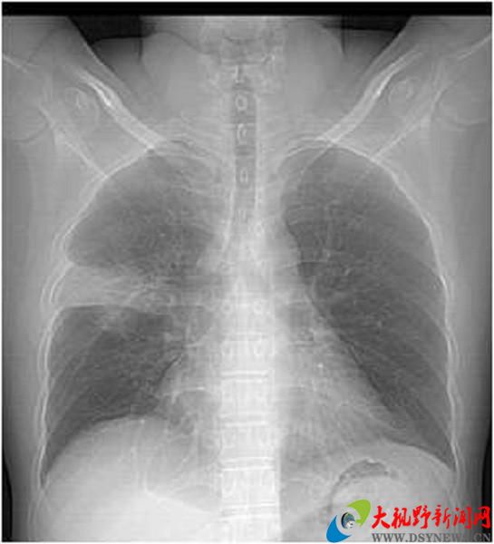 图说:细菌性肺炎胸片图说:细菌性肺炎ct那么,令人惊恐的白肺又是