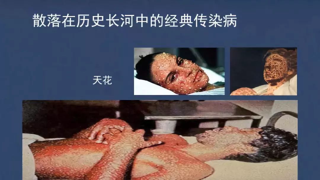 天花死亡率图片