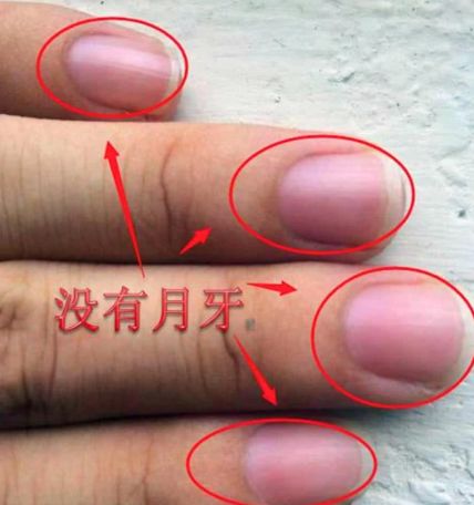 指甲上的小月牙代表什么真的越多越健康越少的越不健康吗