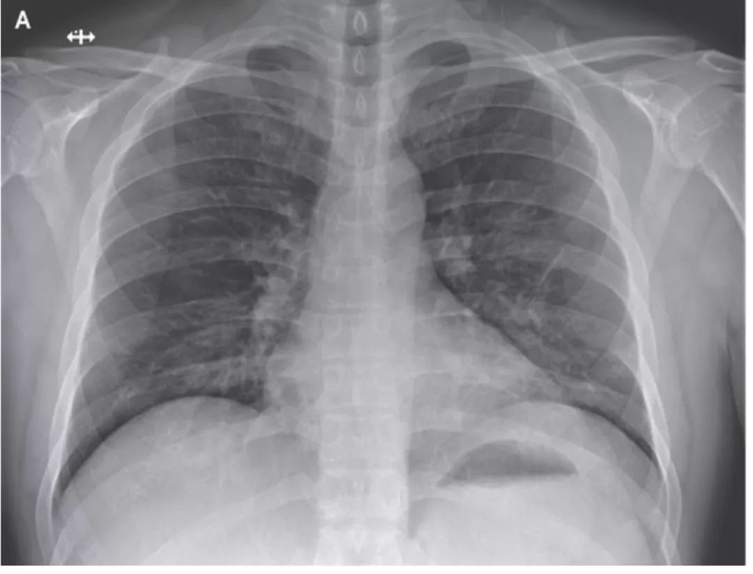 病情迅速好转!美国首例新冠肺炎治疗经过
