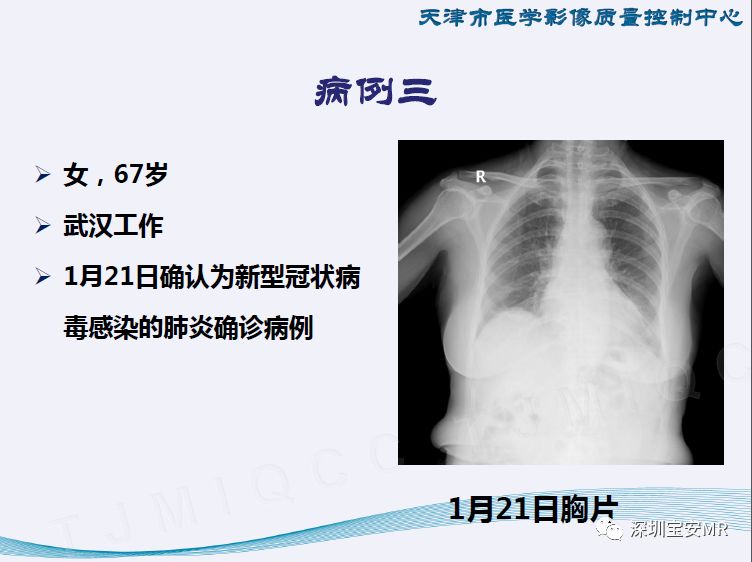 新型冠状病毒感染肺炎影像学表现阶段性总结