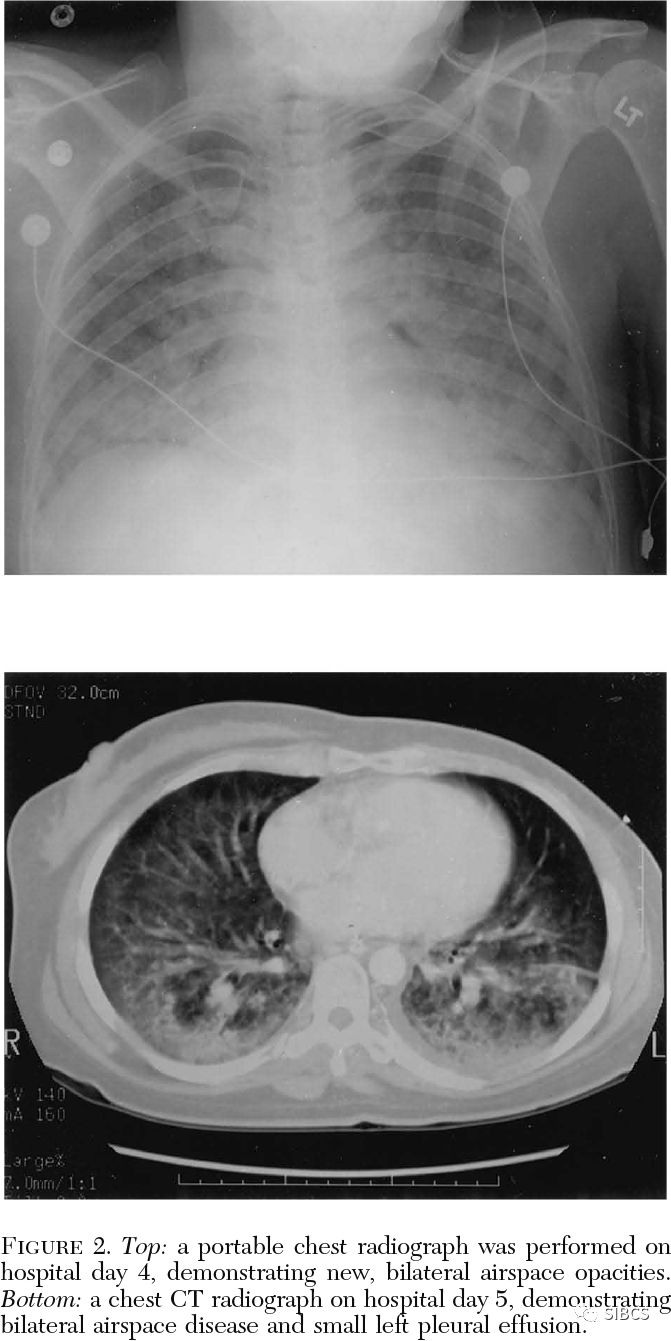 乳腺癌自体骨髓移植术后冠状病毒肺炎_cancer