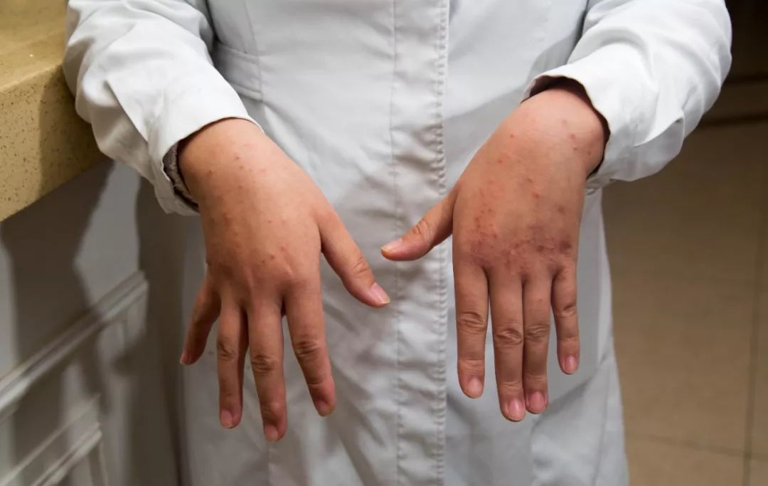 护士张信笛双手长时间浸泡消毒水过敏▲护士聂姜脸上被口罩勒出了