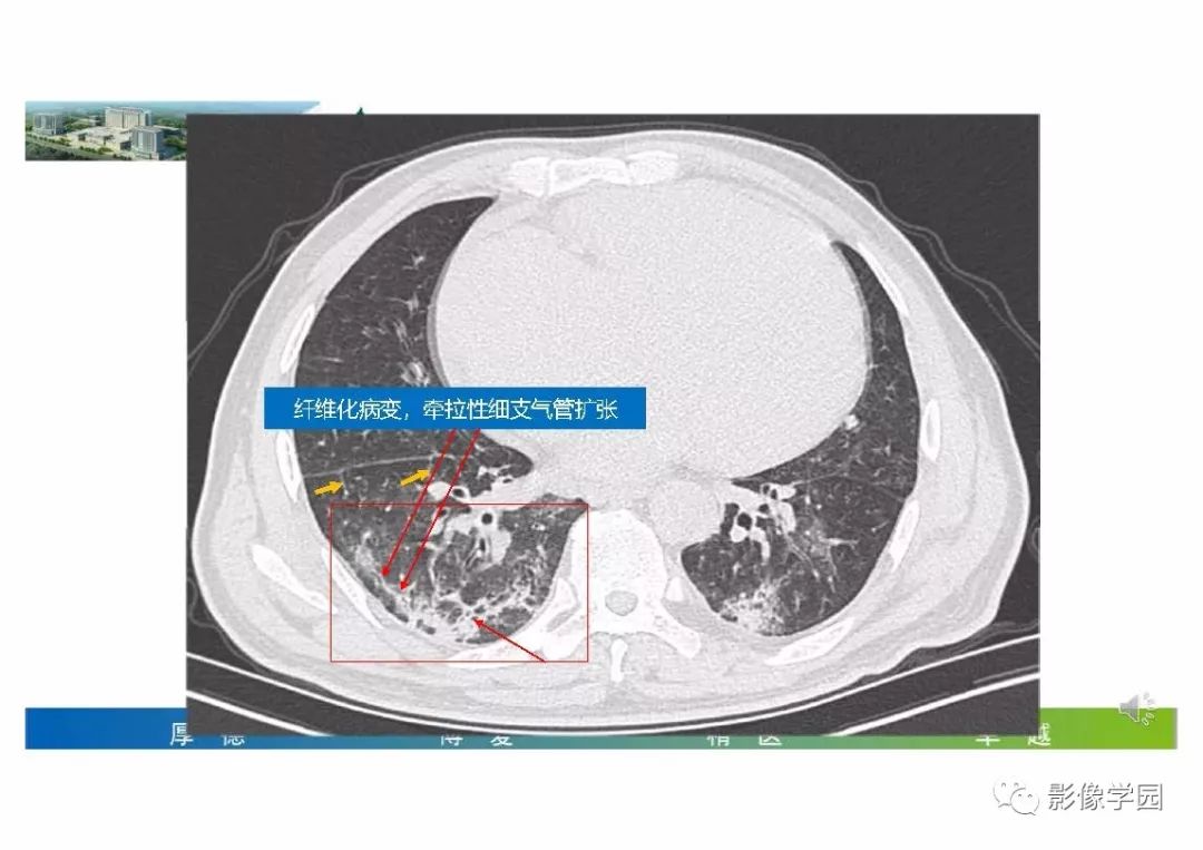 郭佑民教授输入性新冠肺炎的影像学特点与识别