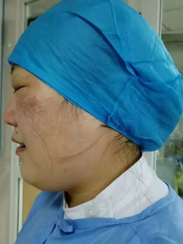 泪目驻马店这些医护人员摘下口罩的样子让人心疼