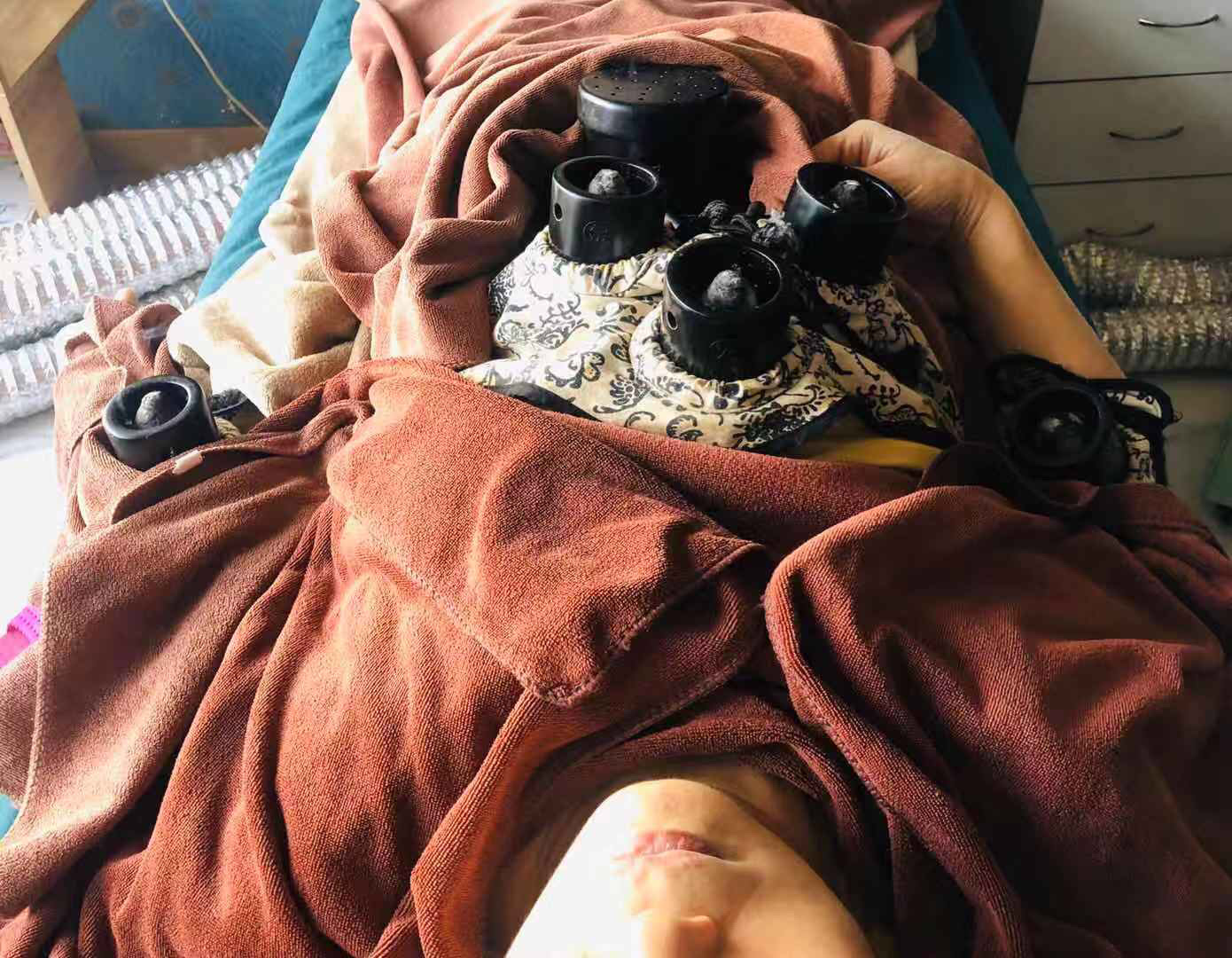 新型冠状病毒防不胜防,每天给高危人群砭灸