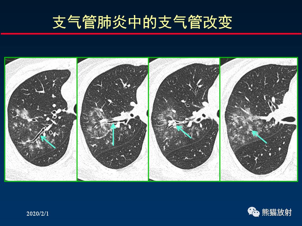 柳澄讲坛丨精准判读支气管感染的基本ct表现