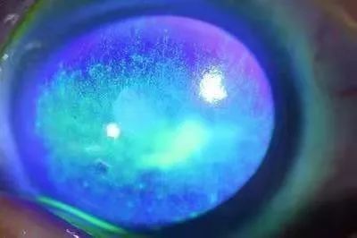 防疫用紫外线照射消毒危险当心引发电光性眼炎