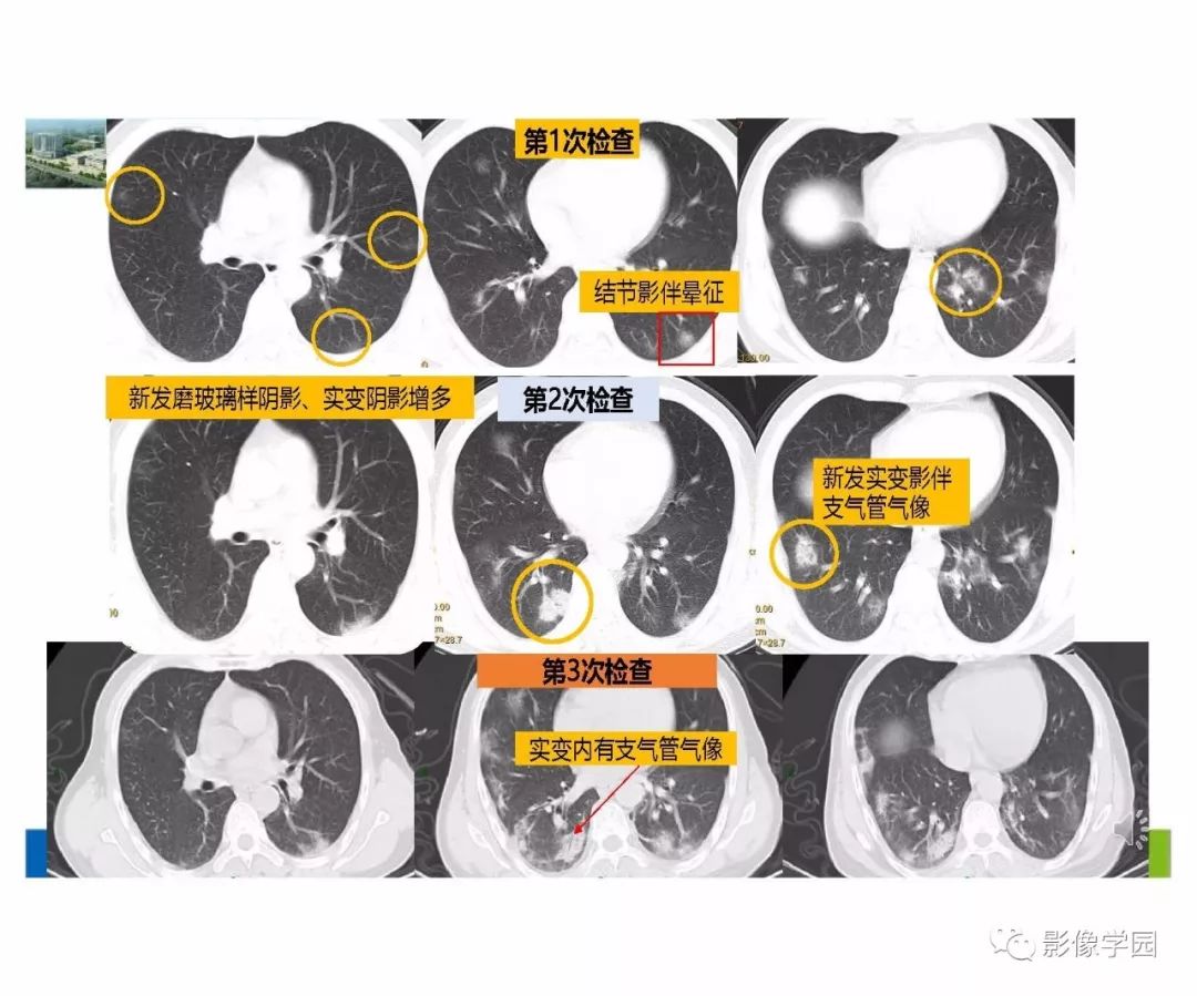 输入性新冠肺炎的影像学特点与识别