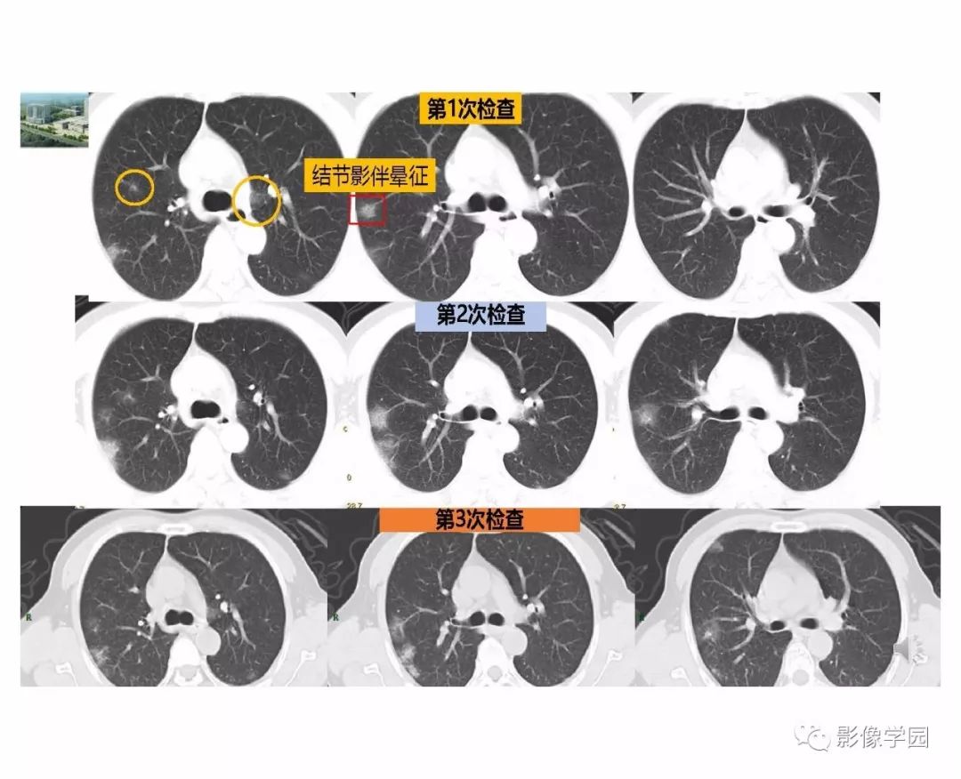 输入性新冠肺炎的影像学特点与识别