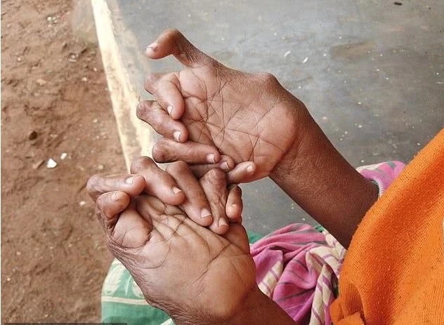 破世界纪录:印度女子12根手指19根脚趾