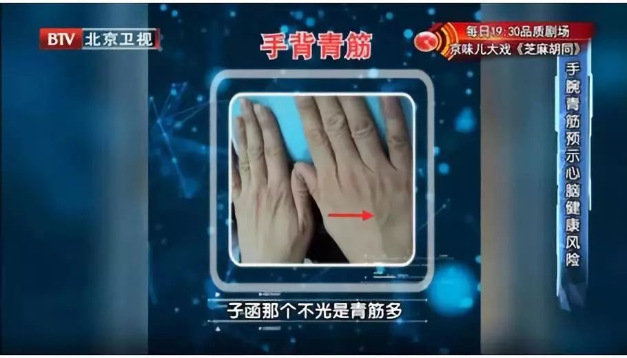 出现垂直于虎口,与掌纹重合的明显青筋,可能预示容易患心脑血管急症