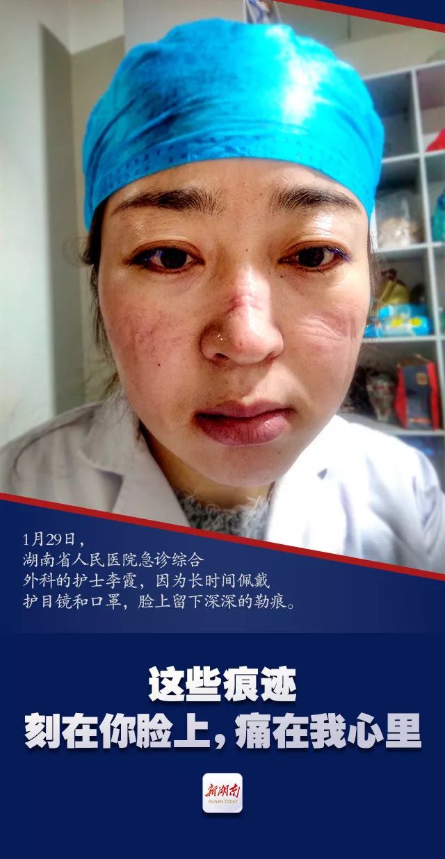 这些痕迹刻在你脸上痛在我心里