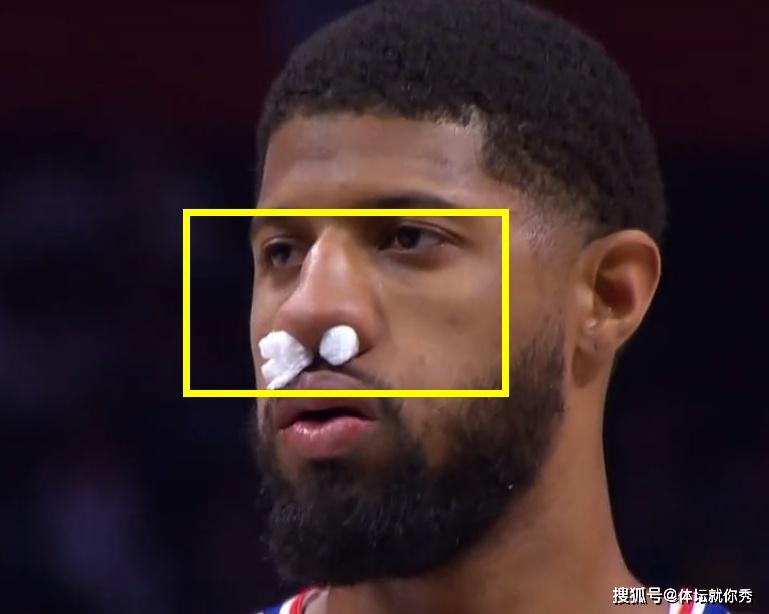 德罗赞太狠了,一肘子将乔治鼻梁打歪,瞬间肿的像小馒头_鼻子