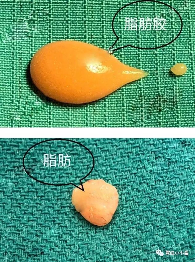 为了变"肥"为宝,医生们吐了100多年血了! |日本医美_脂肪