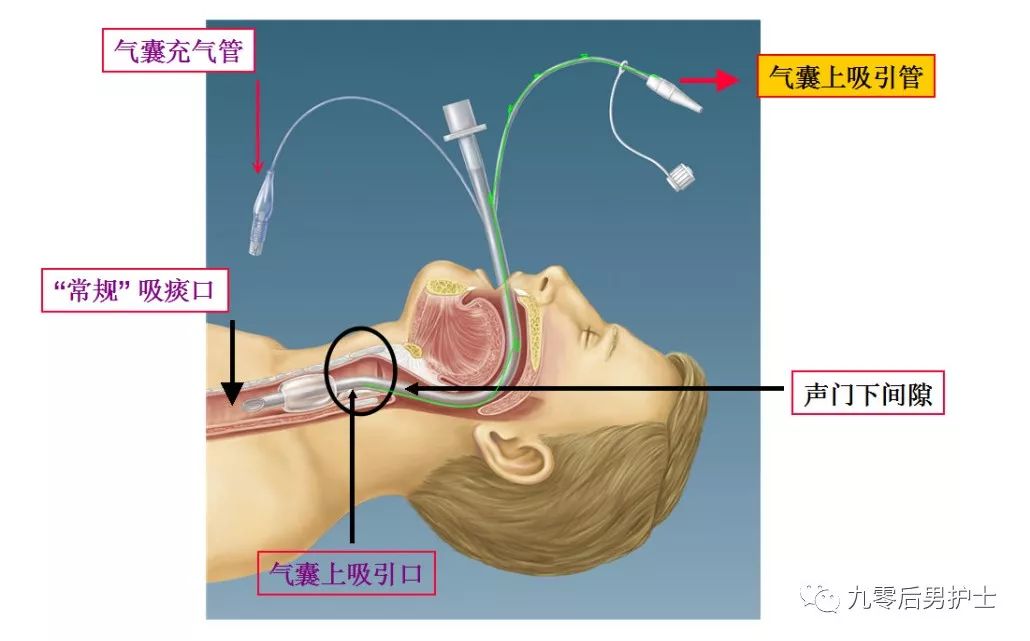 “声门下吸引”在机械通气患者中那些事儿_气囊