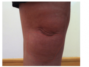 什么是髌下脂肪垫?为什么会影响膝盖功能?什么是髌下脂肪垫?