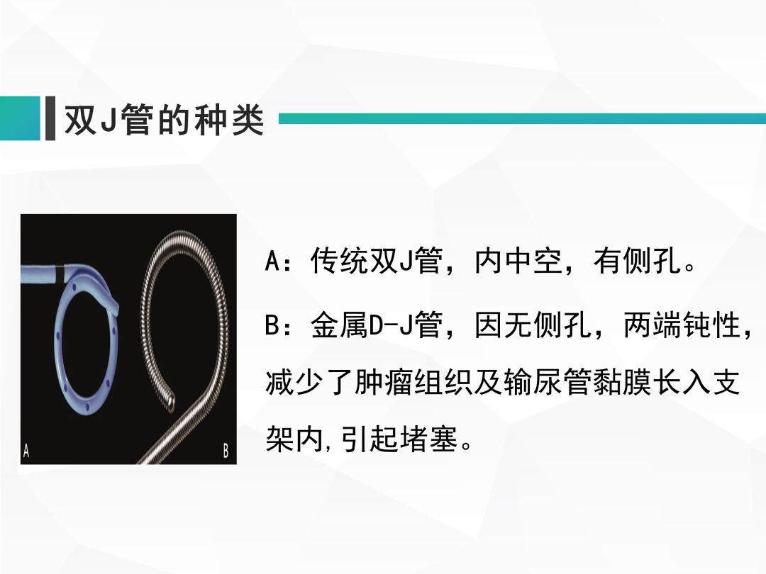 【ppt】双j管在泌尿系手术中的应用及护理_&amp