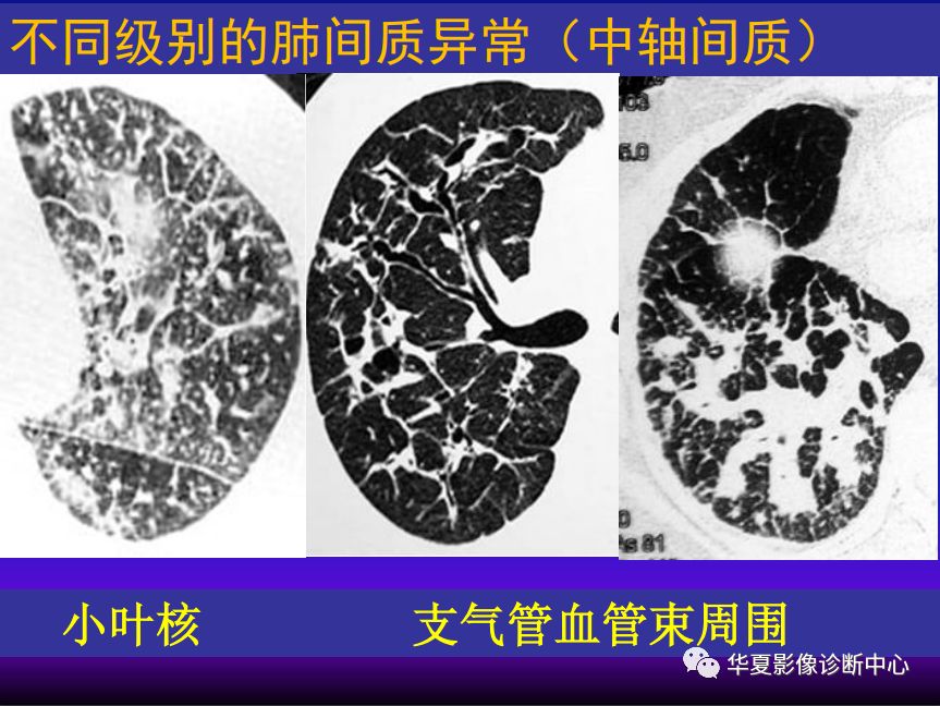 肺间质性疾病的解剖病理影像分析