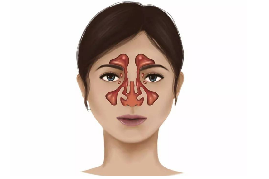 急性筛窦炎的痛感可以说是最轻的,痛感几种在眼眶内或眼内眦两侧
