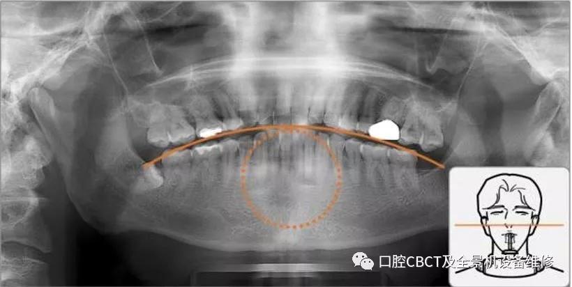 口腔全景机cbct拍片注意事项