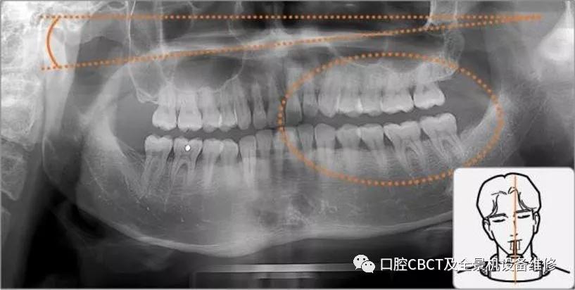 口腔全景x光机建议操作流程及注意事项