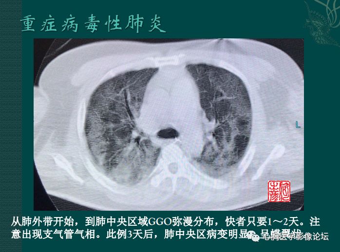 病毒性肺炎概念与ct表现