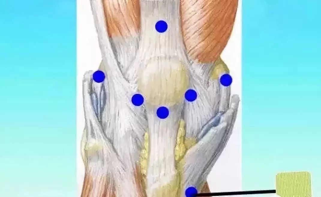 【图文】五指定位法针刀整体松解术治疗膝关节骨性关节炎
