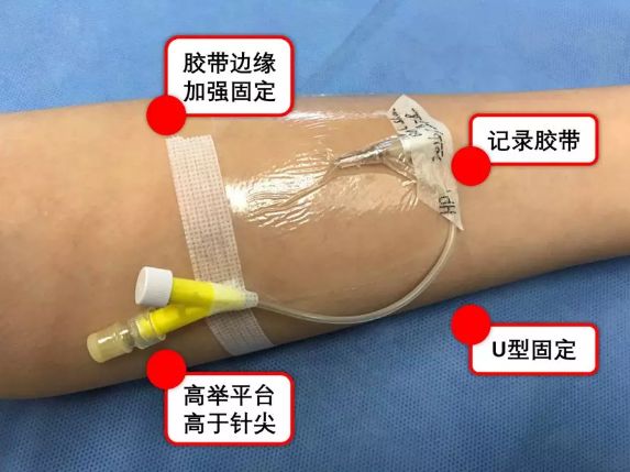 输液胶布固定方法图片图片