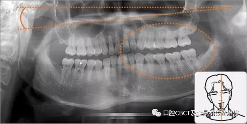 口腔全景片定位线图片